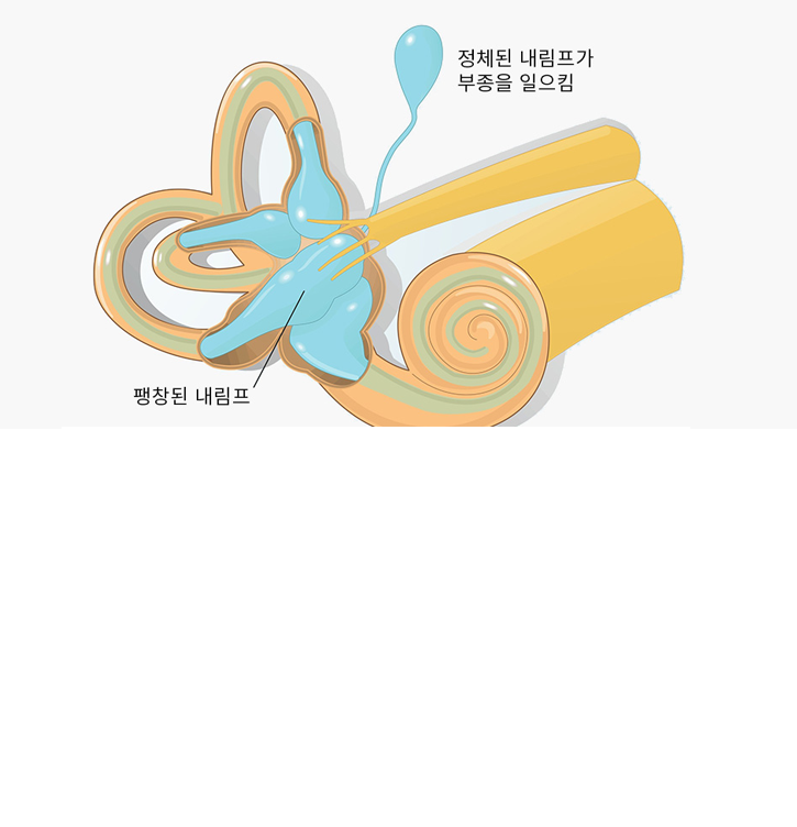 내이 그림 — 팽창된 내림프 표시