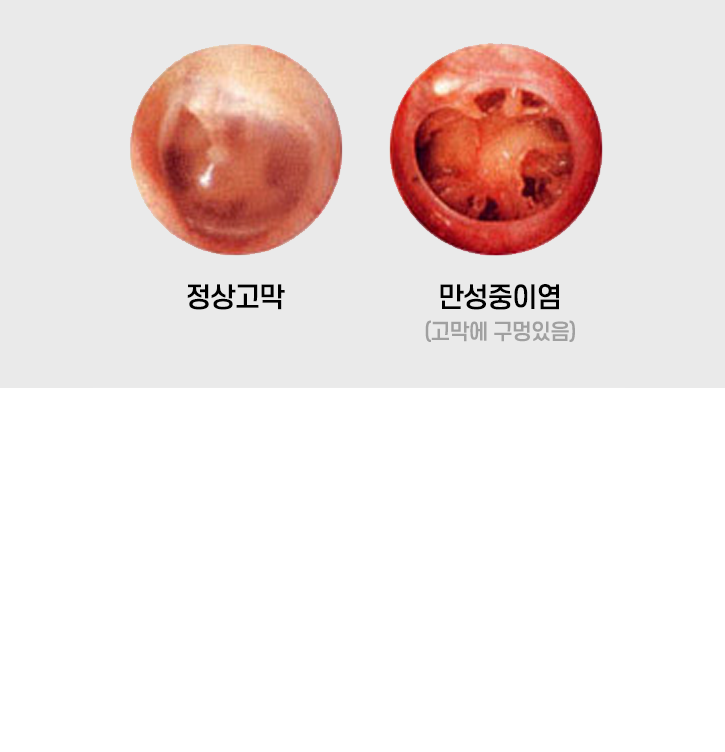 정상 고막과 고막에 구멍이 난 만성중이염 고막의 내시경 사진 비교