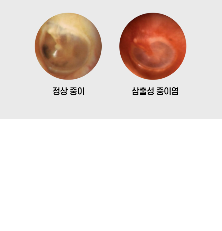 정상 중이와 삼출성 중이염 고막의 내시경 사진 비교